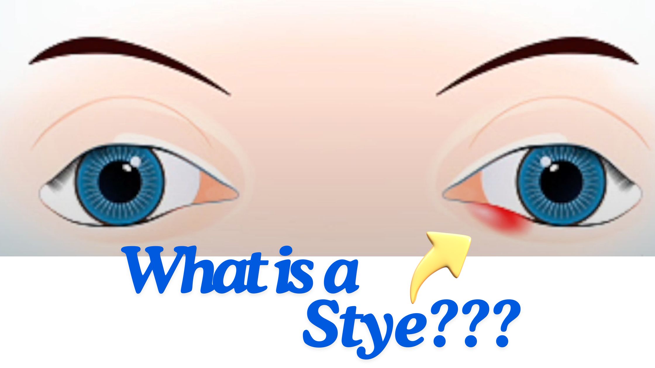 Read more about the article What Is a Stye? Causes, Symptoms, and Effective Treatments