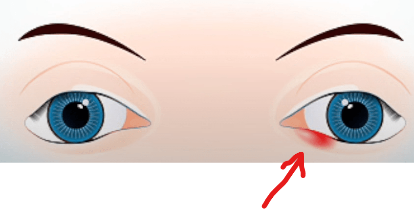 Close-up image of a human eye with a stye on the lower eyelid of the right eye. The stye appears as a red, swollen bump near the edge of the eyelid, slightly inflamed and tender. The surrounding skin shows mild redness, indicating irritation